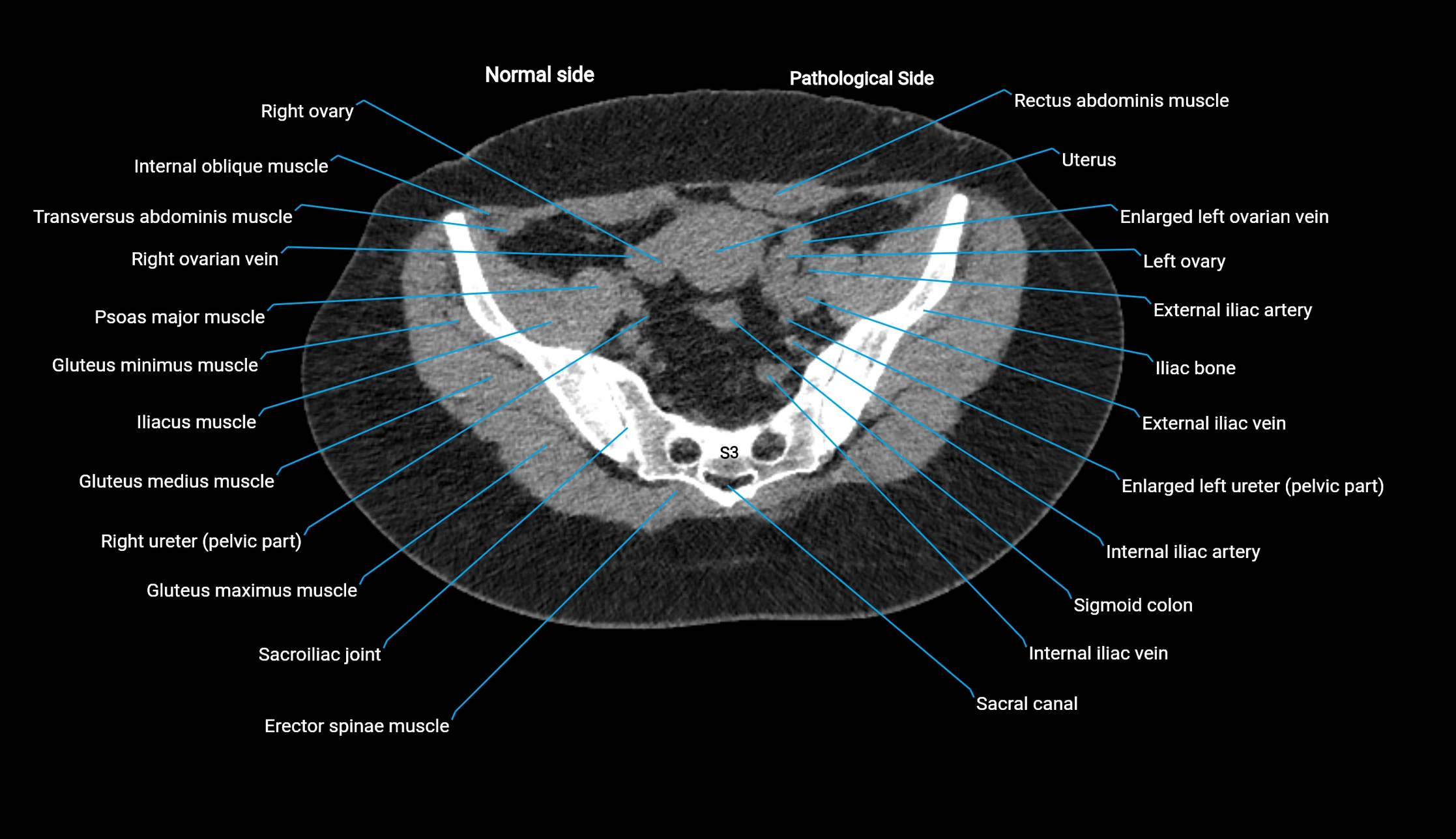 CT KUB axial cross sectional anatomy  radiology image -img-00201-00128.webp